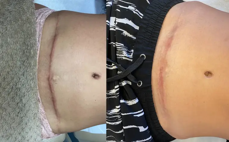 Antes e depois — tratamento de queloide